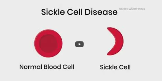sickle cell anemia