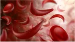 Sickle Cell Anemia