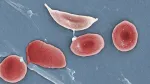 sickle cell anemia