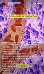 sickle cell blocking blood flow