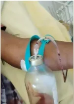 Sickle Cell Anemia