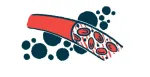 Sickle Cell Anemia