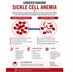 Sickle Cell Anemia