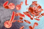 Sickle Cell Anemia