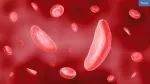 Sickle Cell Anemia