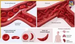 Sickle Cell Anemia