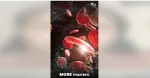 Sickle Cell Anemia