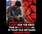 Sickle Cell Anemia
