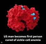 Sickle Cell Anemia
