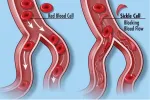 Sickle Cell Anemia