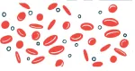 Sickle Cell Anemia