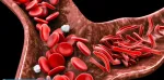 Sickle Cell Anemia