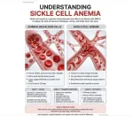 Sickle Cell Anemia