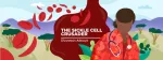 Sickle Cell Anemia