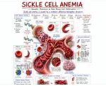Sickle Cell Anemia