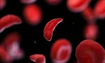 sickle cell anemia