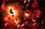 Sickle Cell Anemia