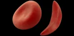 Sickle Cell Anemia