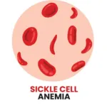 sickle cell anemia