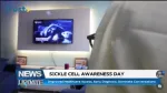 sickle cell anemia