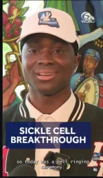 sickle cell anemia
