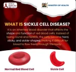 sickle cell anemia