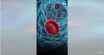 sickle cell anemia