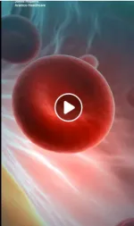 sickle cell anemia