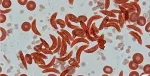 sickle cell anemia