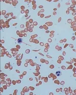 sickle cell anemia
