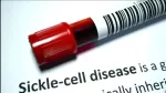Sickle Cell Anemia