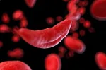 sickle cell anemia