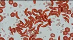 sickle cell anemia