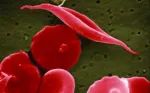 sickle cell anemia