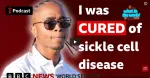 sickle cell anemia