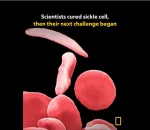 sickle cell anemia