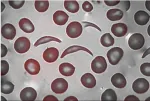 sickle cell anemia