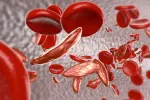 sickle cell anemia