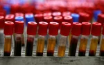 sickle cell anemia