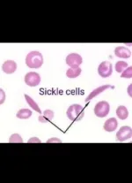 sickle cell anemia