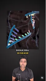 sickle cell anemia