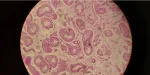 sickle cell anemia