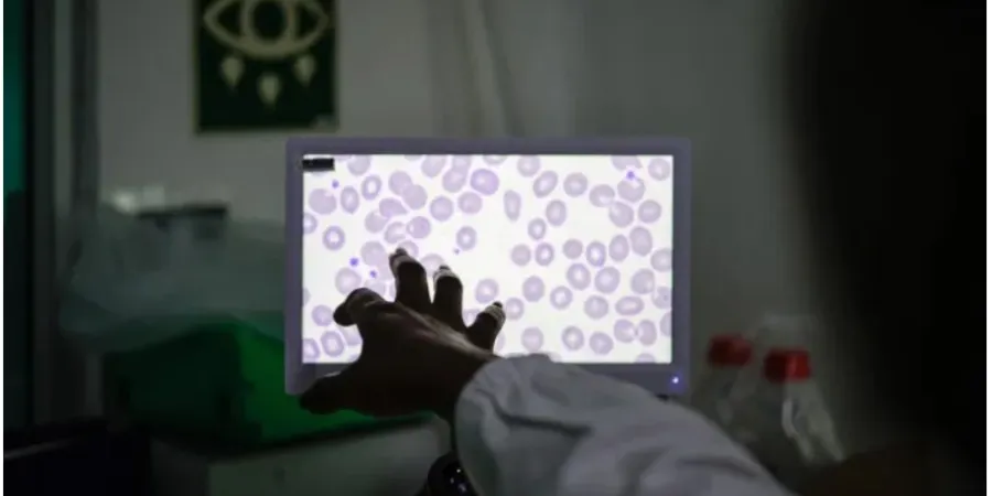 sickle cell anemia