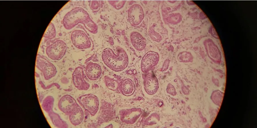 sickle cell anemia