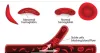 Sickle Cell Anemia