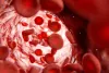 sickle cell anemia